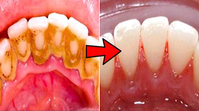 3 Dentist Tips for Removing Dental Tartar Yourself.