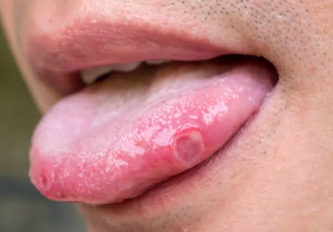 A simple and powerful natural remedy for canker sores