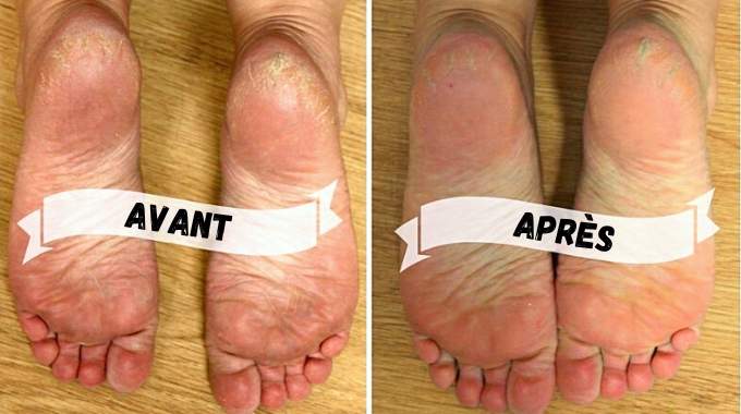 10 Miracle Remedies for Dry and Cracked Heels.